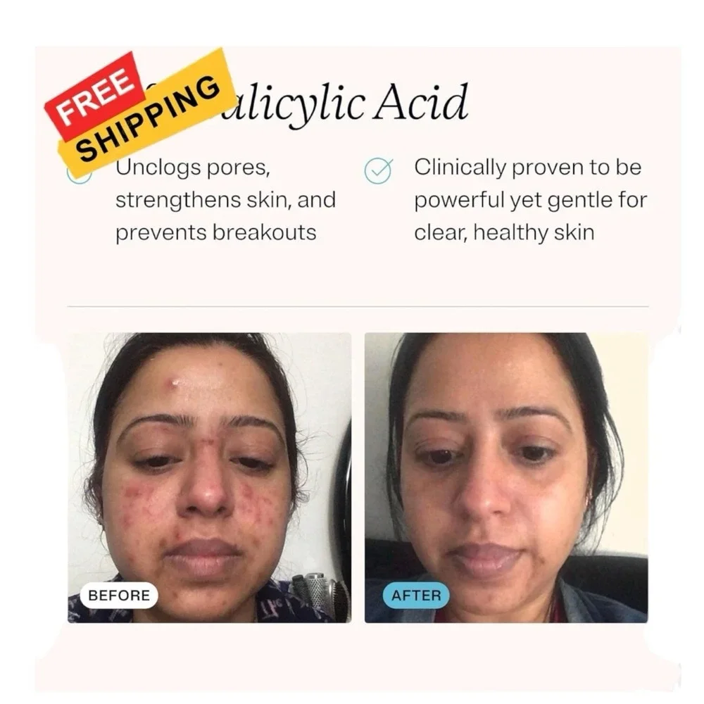 MDacne Hydrating Facial Cleanser & Moisturizer Salicylic Acid .5% Acne Treatment